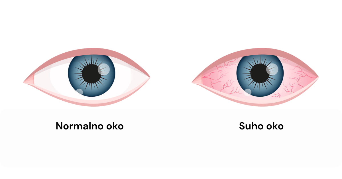 Suho oko – uzroci, simptomi i kako si pomoći